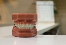 What You Need to Know About Your Wisdom Teeth